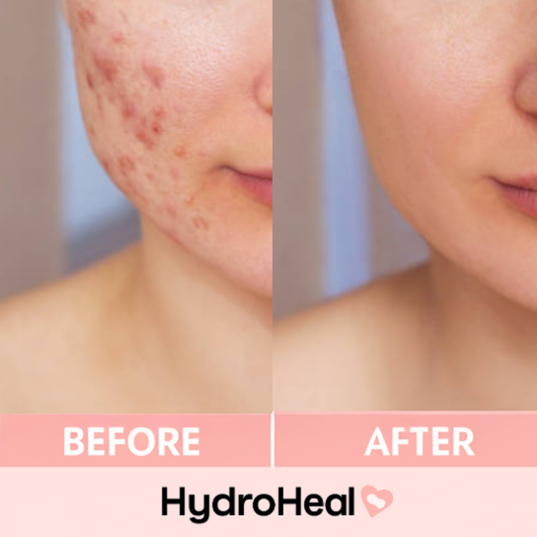 HydroHeal™ Medical Hydrocolloid Roll